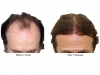 hair-transplant-photo-105