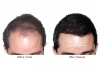 hair-transplant-photo-109