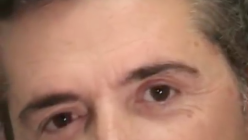 Transplante de cejas