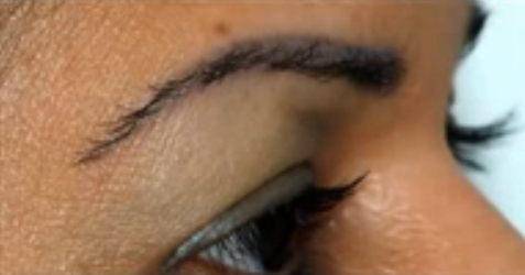 Trasplante de Cejas con la doctora Alba Reyes Sagiv