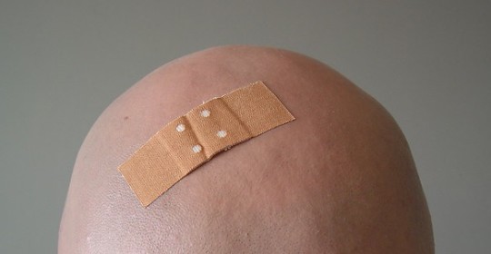 ¿ Qué tan doloroso resulta el tratamiento de trasplante capilar?